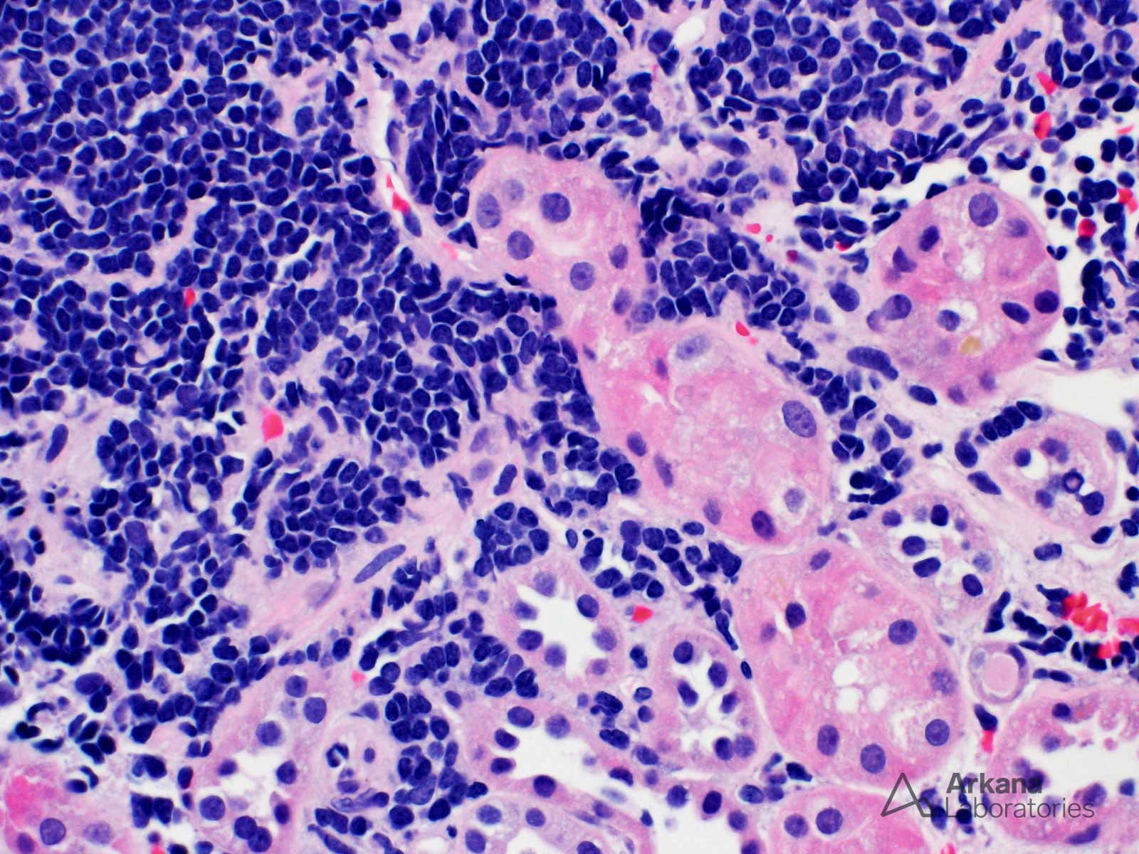 Lymphocytic Leukemia (CLL and SLL)