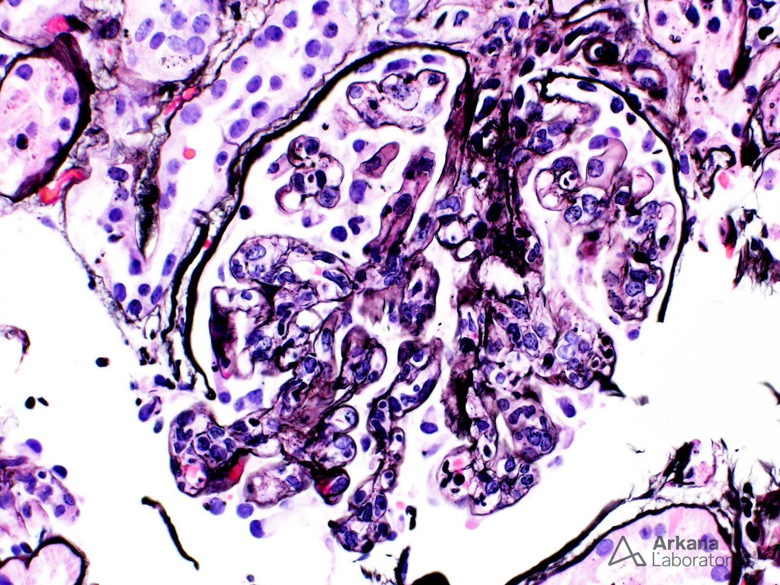 Lymphocytic Leukemia (CLL and SLL)