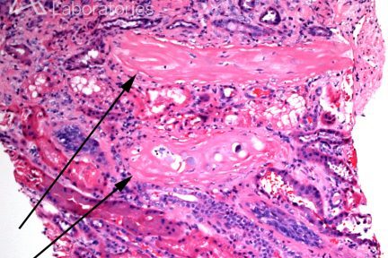 Sclerosing Peritubular Nodule