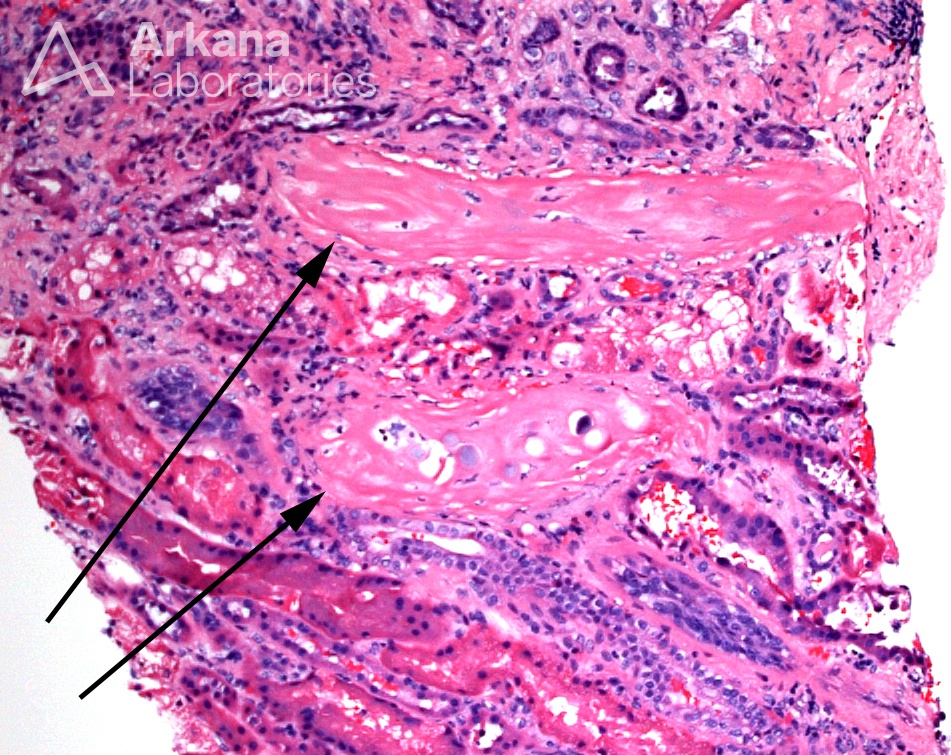 Sclerosing Peritubular Nodule