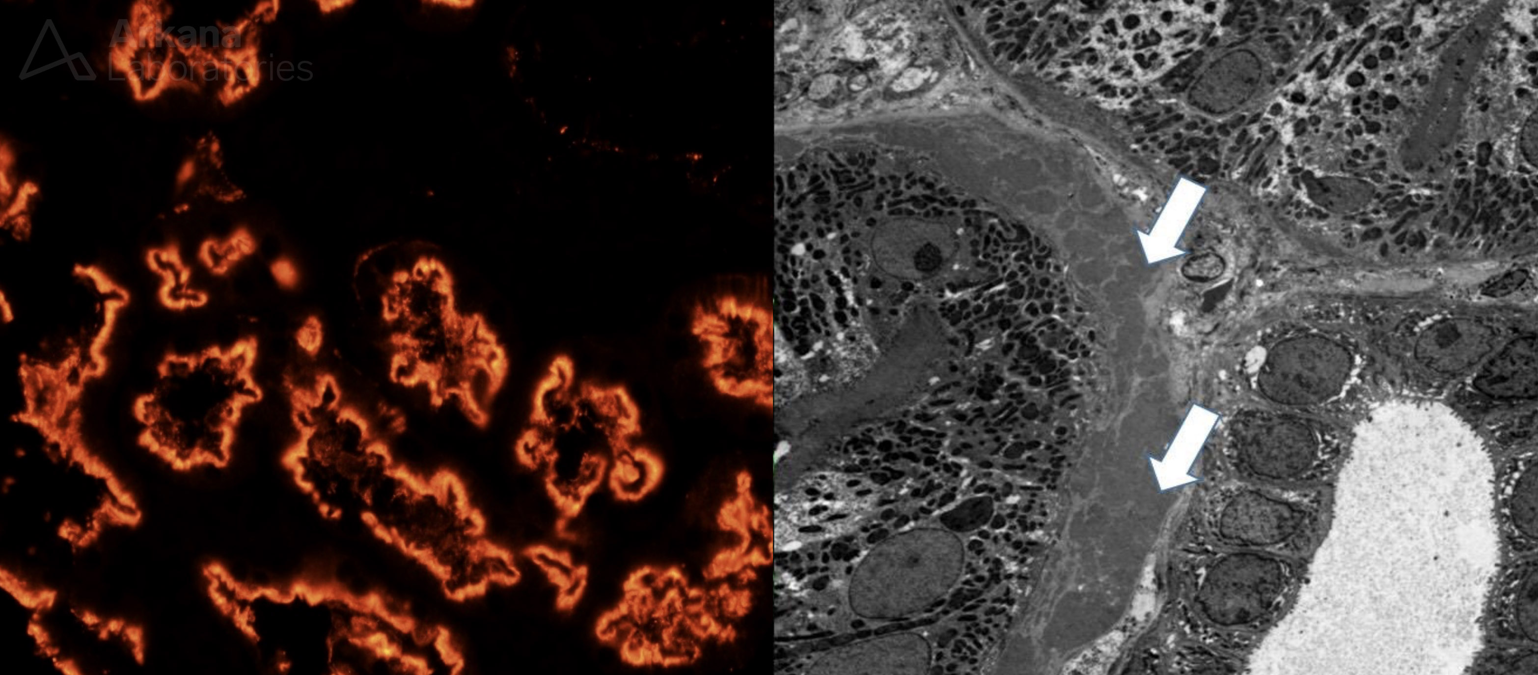 Anti-Brush Border Antibody Disease imaging