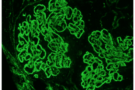 Membranous Glomerulopathy Subtyping, Arkana Laboratories, Renal Pathology Teaching Points