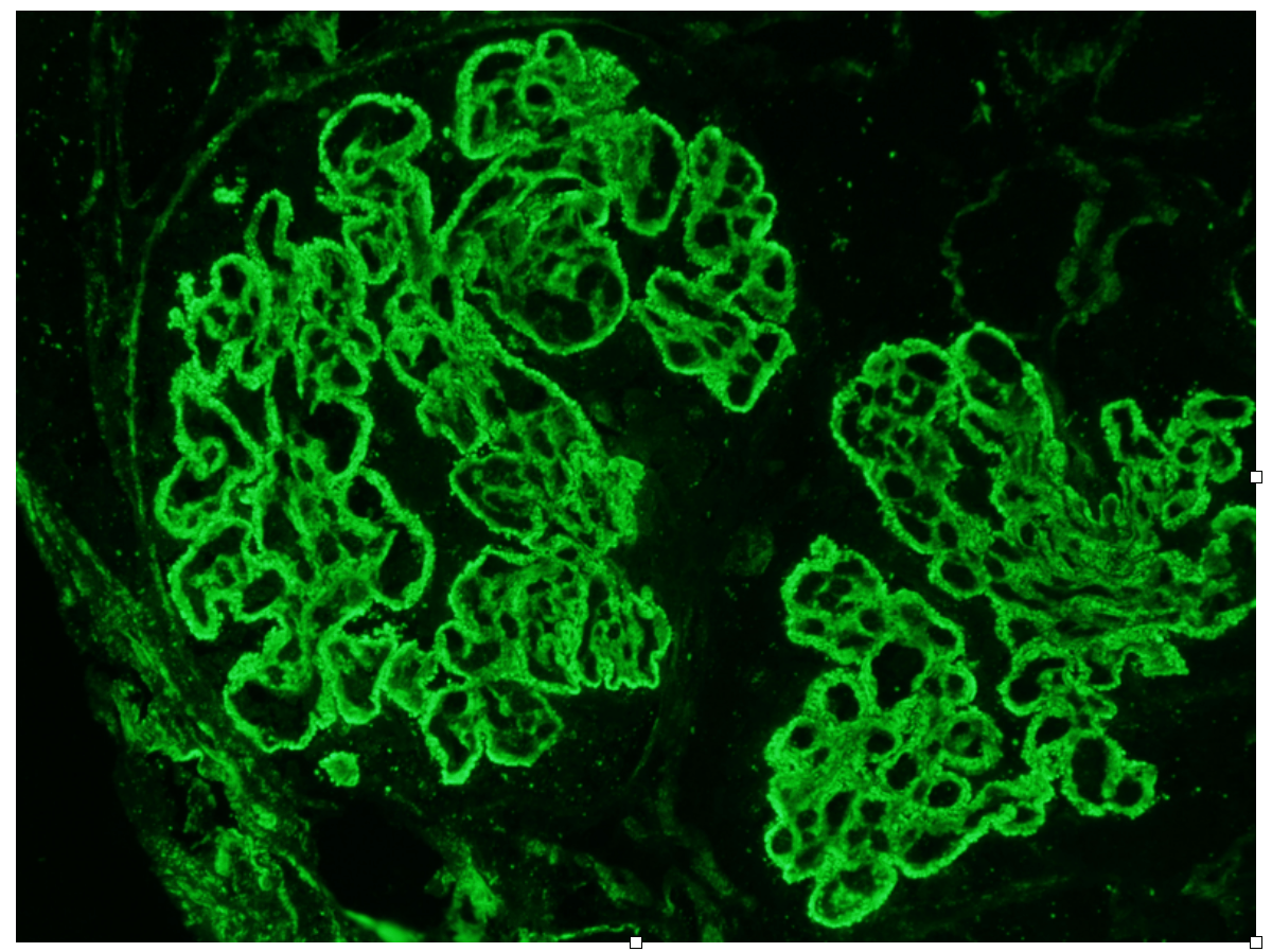 Membranous Glomerulopathy Subtyping, Arkana Laboratories, Renal Pathology Teaching Points