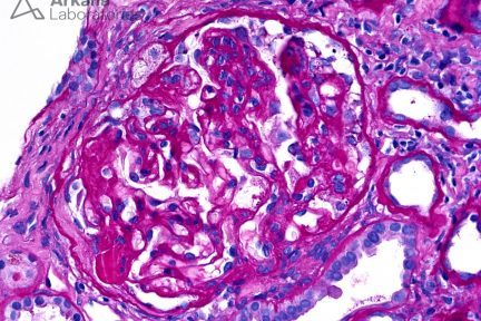 FSGS, focal segmental glomerulosclerosis