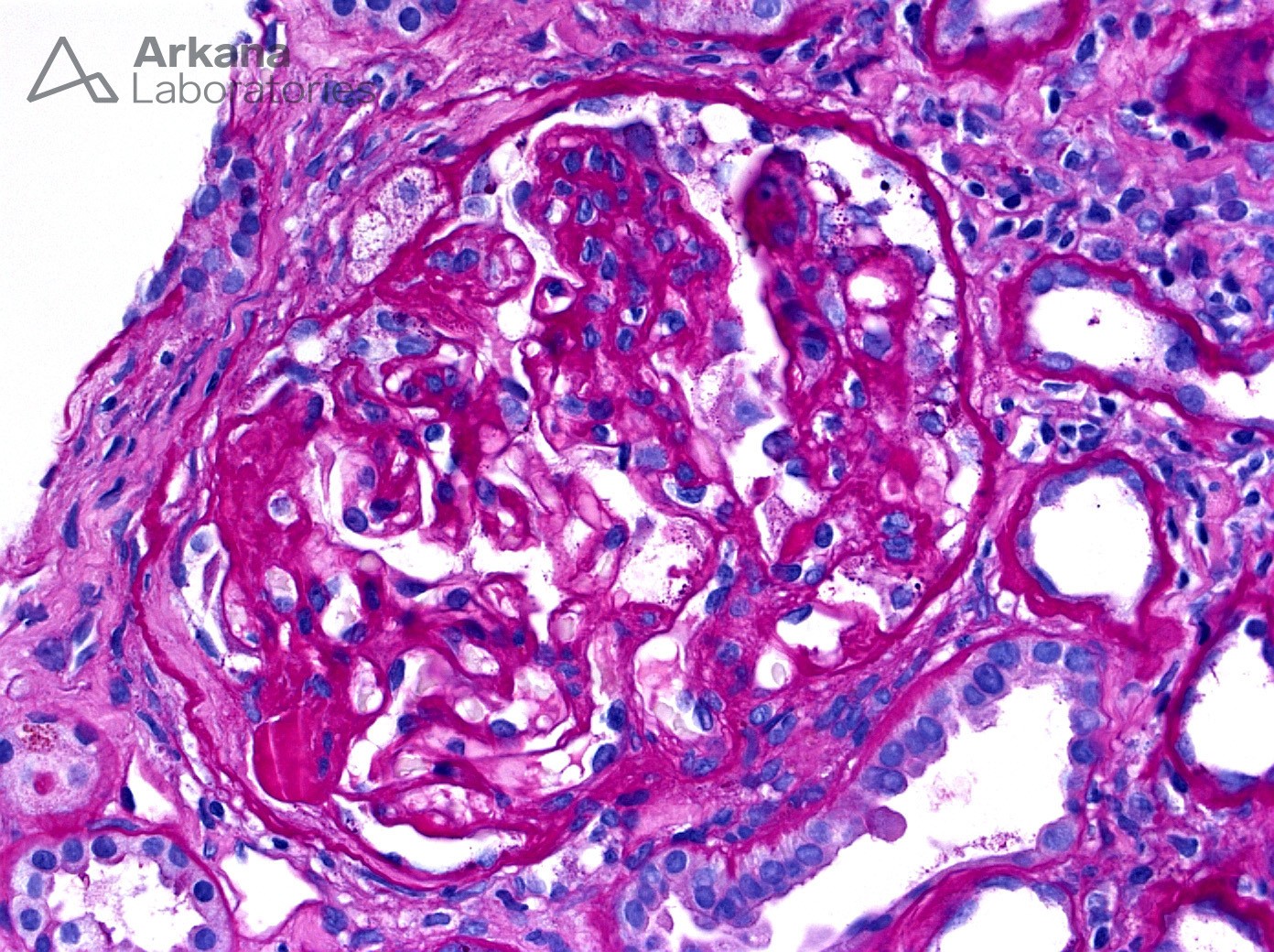 FSGS, focal segmental glomerulosclerosis