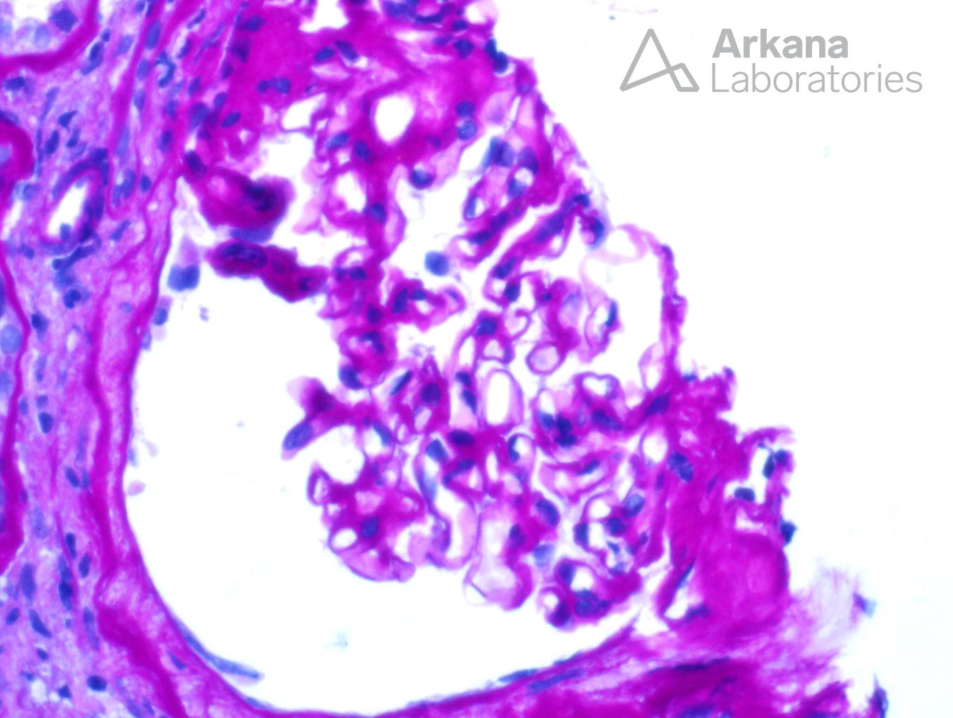 Granulomatous Interstitial Nephritis