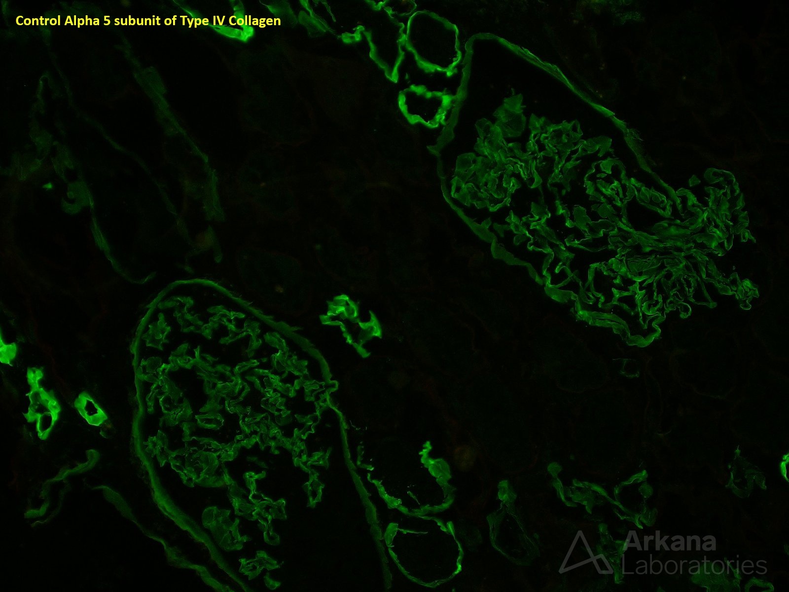 Alport Syndrome