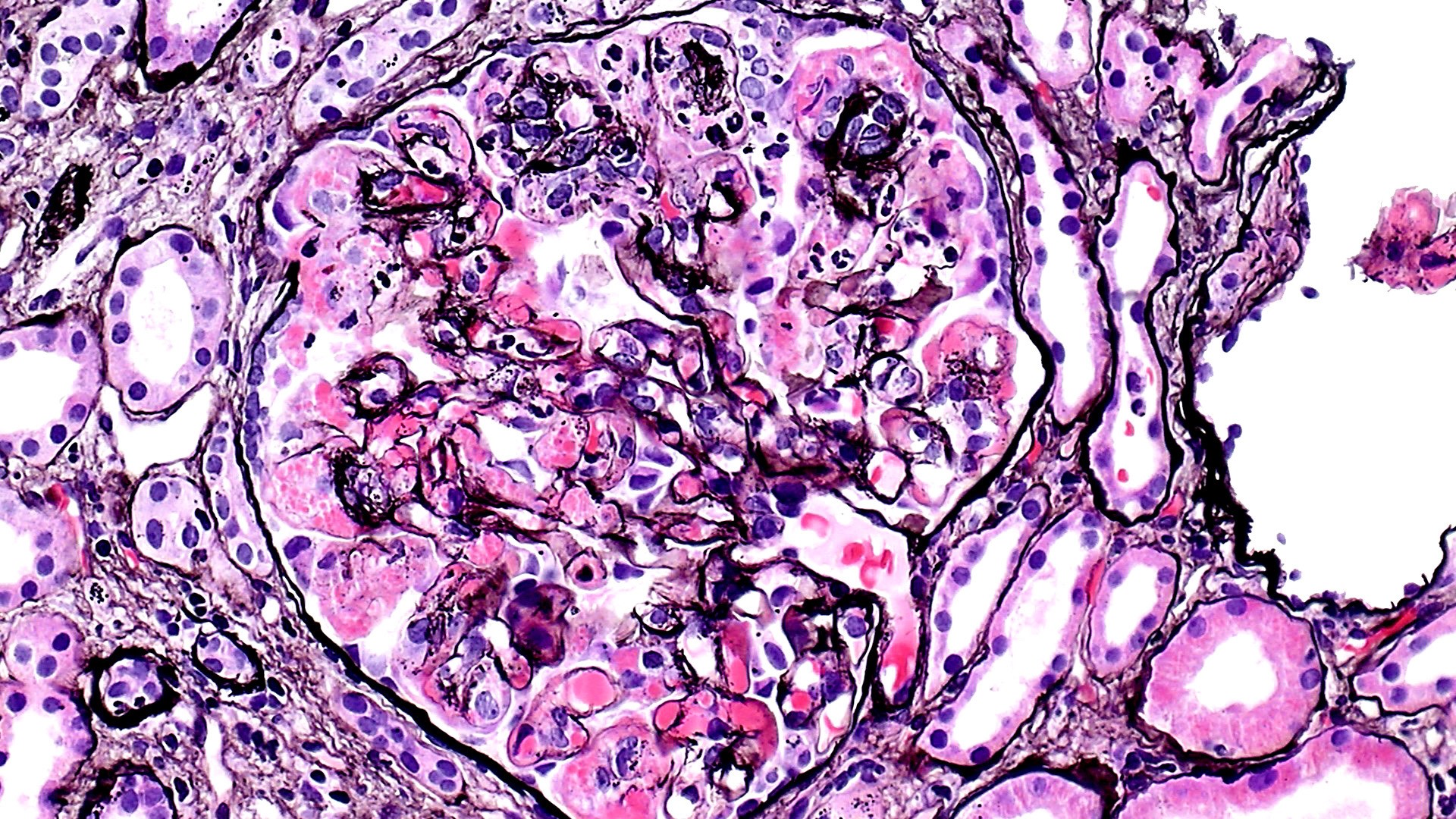 type I cryoglobulinemic glomerulonephritis