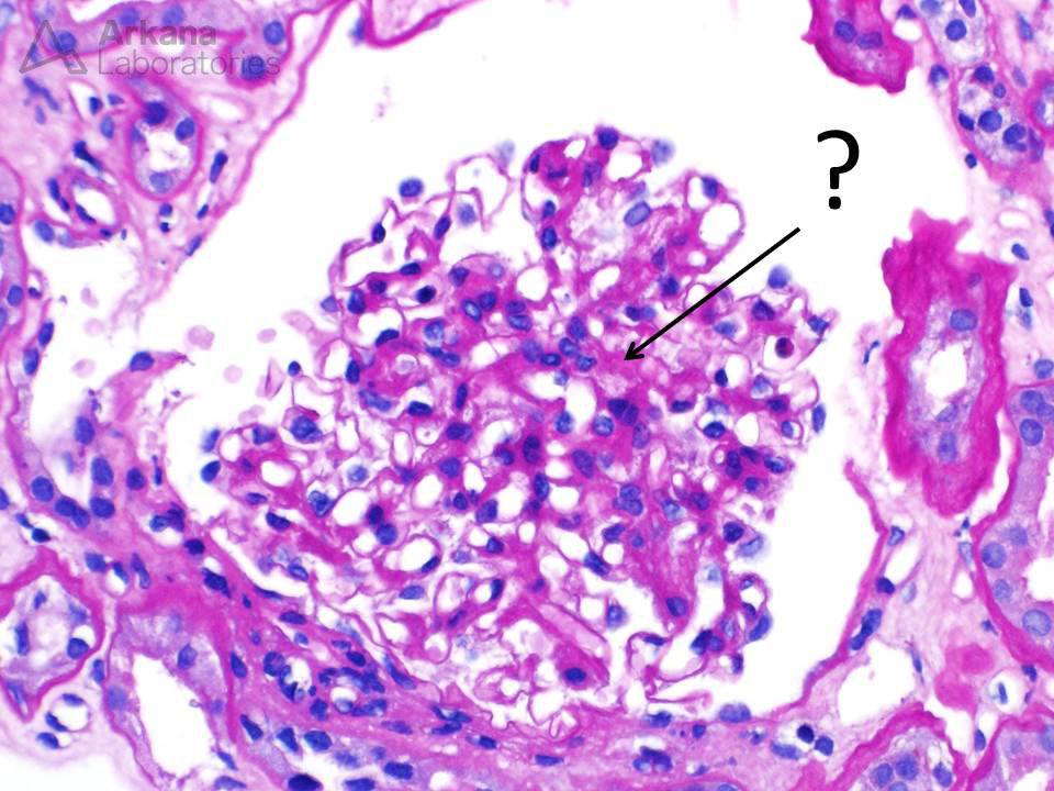 DNAJB9 Uncovers Dual Pathology