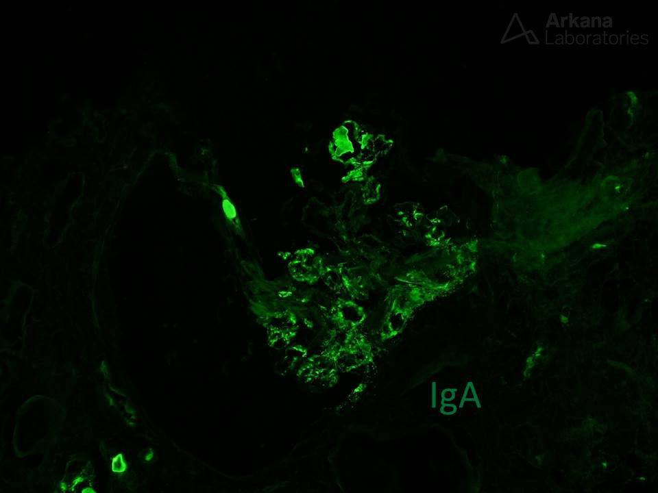 IgA staining, DNAJB9 Uncovers Dual Pathology