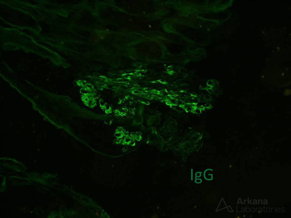 IgG stain, DNAJB9 Uncovers Dual Pathology