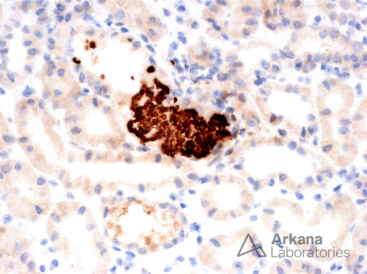 myoglobin casts, Rhabdomyolysis