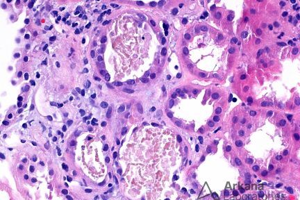 Rhabdomyolysis