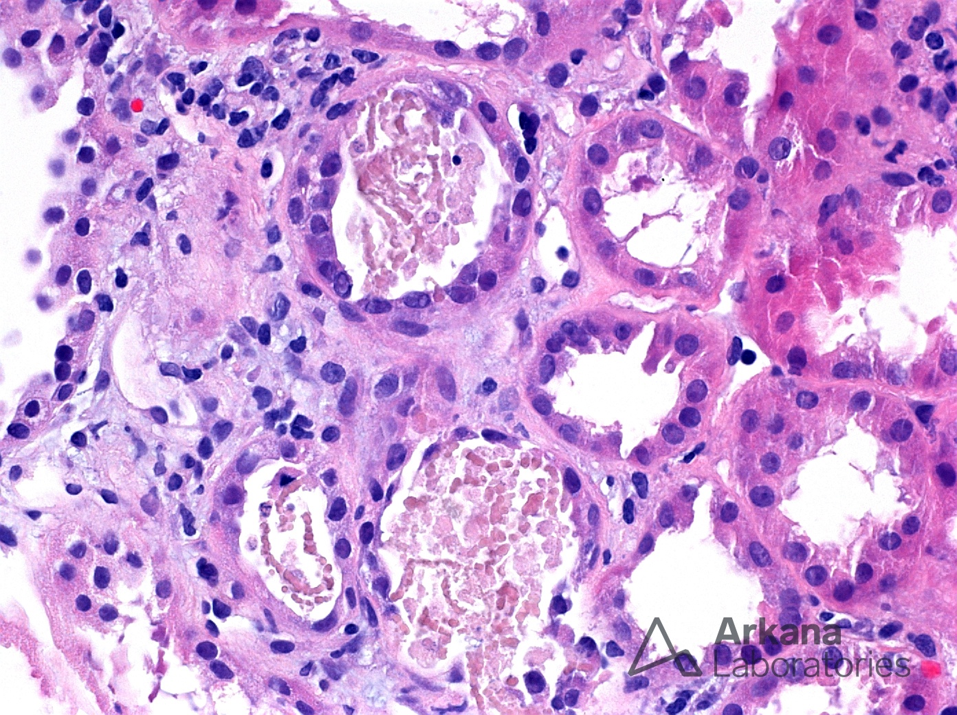 Rhabdomyolysis