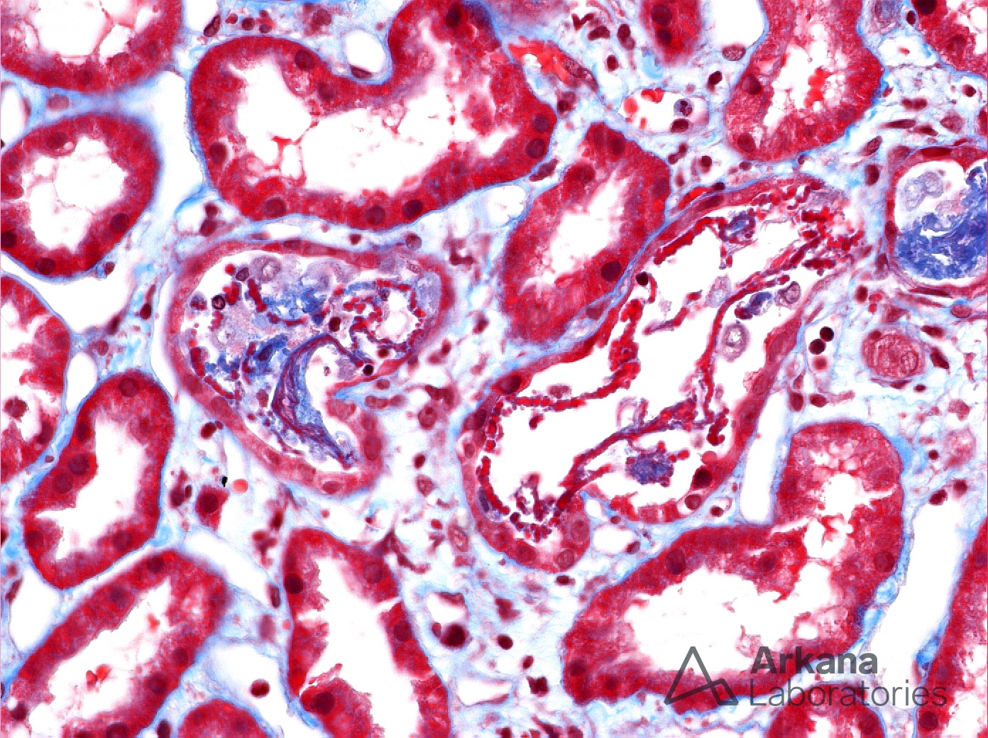 myoglobin casts, Rhabdomyolysis 