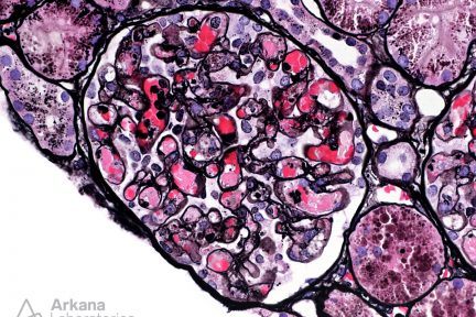 thrombotic microangiopathy