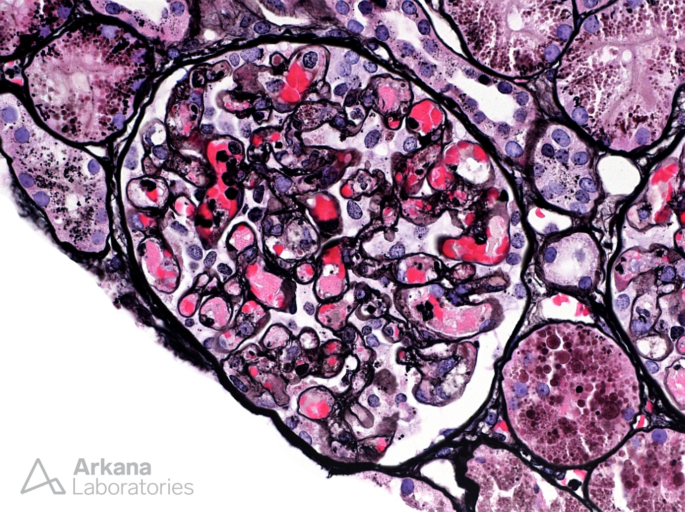 thrombotic microangiopathy