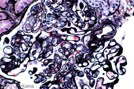 Active Antibody Mediated Rejection