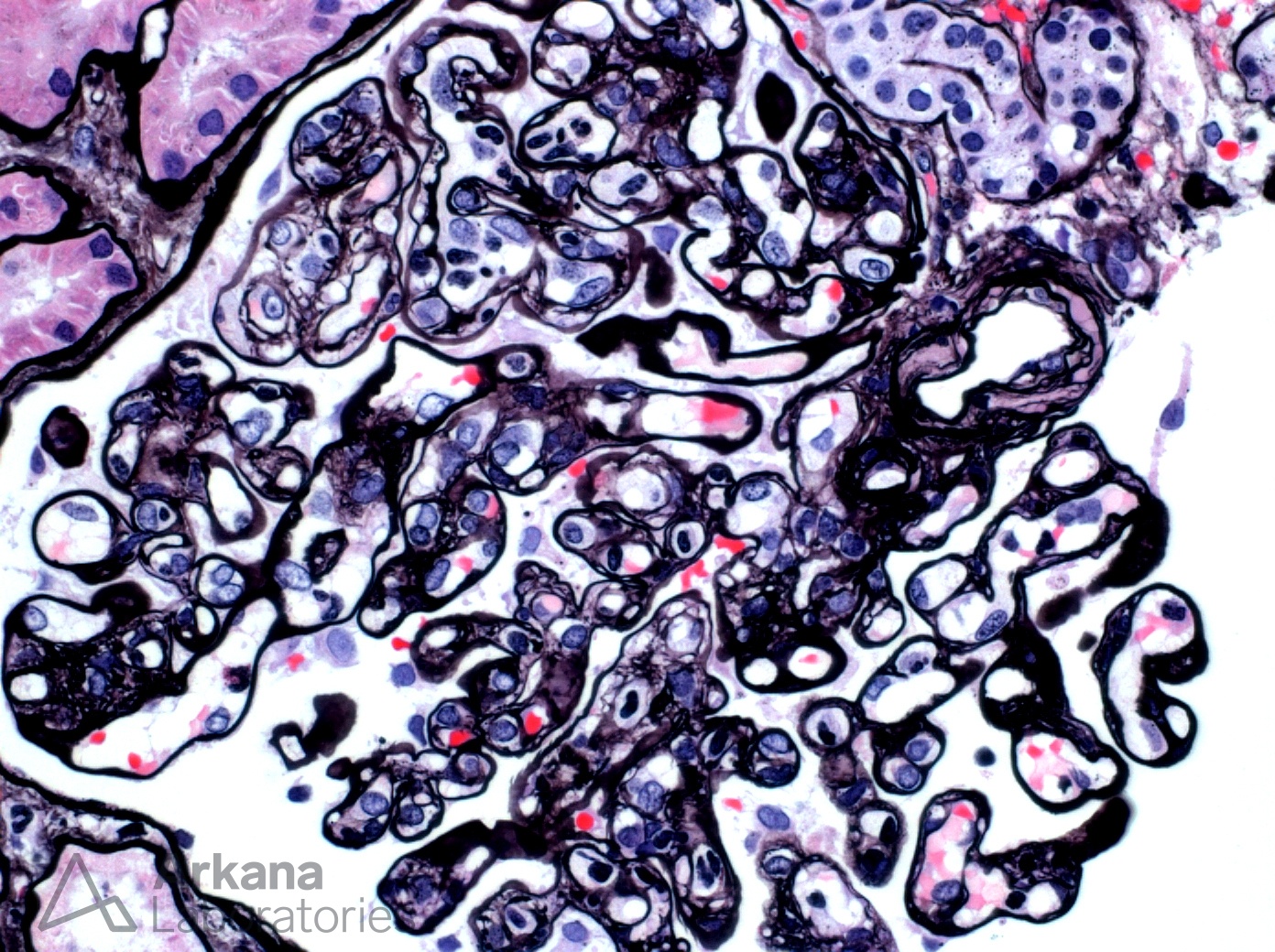 Active Antibody Mediated Rejection