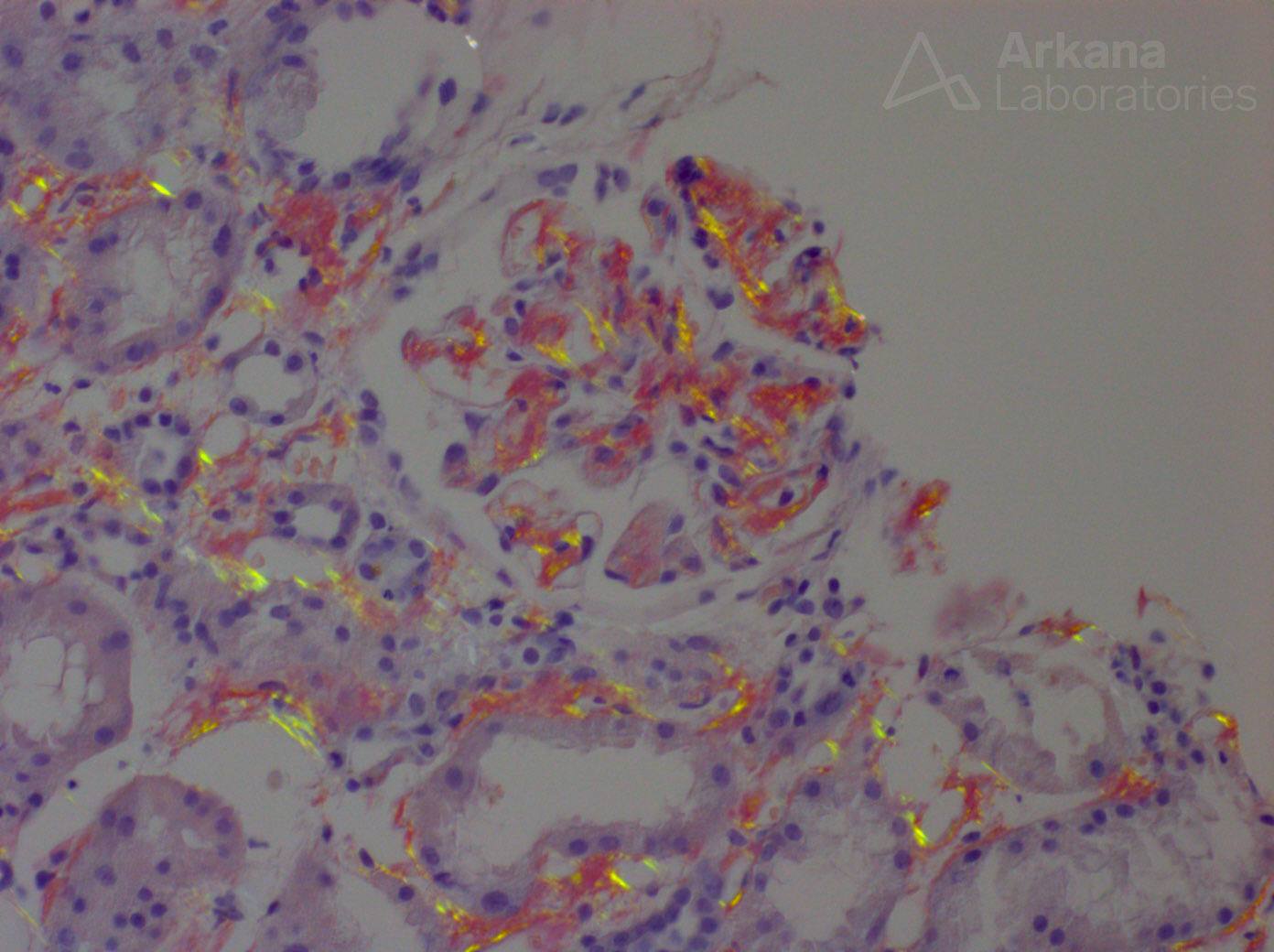 AL-type Amyloidosis stain