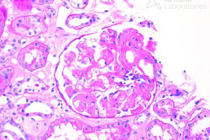 AL-type Amyloidosis, arkana laboratories, diagnose this, renal path, kidney path, nephropath, chronic kidney disease