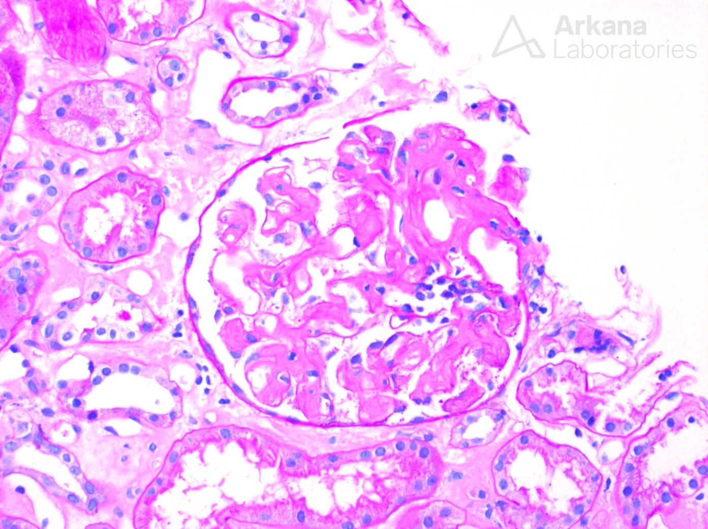 AL-type Amyloidosis, arkana laboratories, diagnose this, renal path, kidney path, nephropath, chronic kidney disease