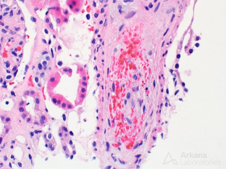 Thrombotic Microangiopathy images