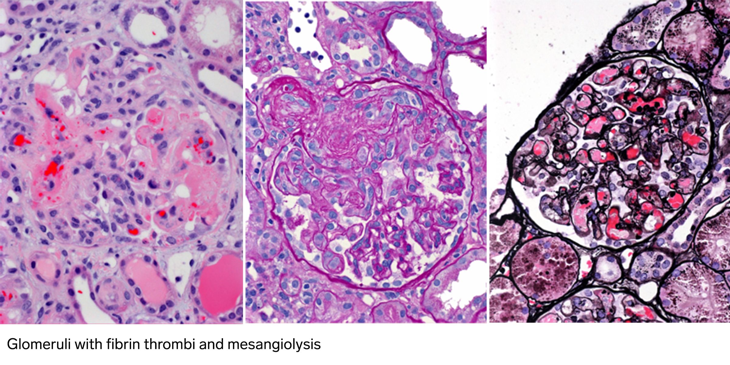 Thrombotic Microangiopathy Sequencing Panel, TMA, renal biopsy