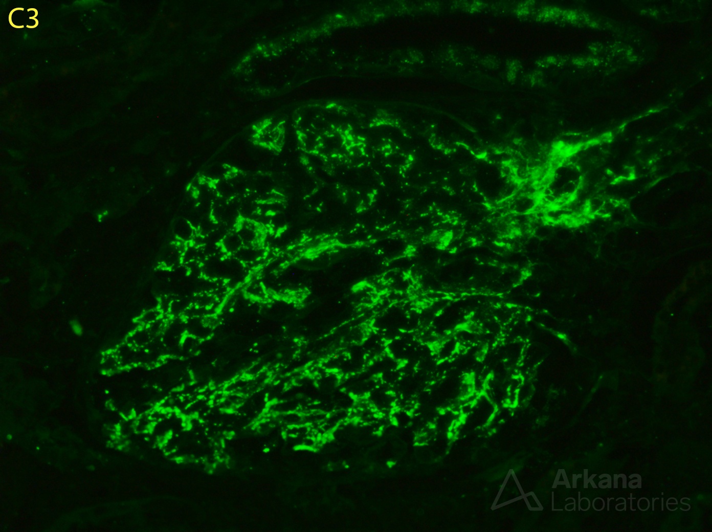 Infection-Associated Glomerulonephritis