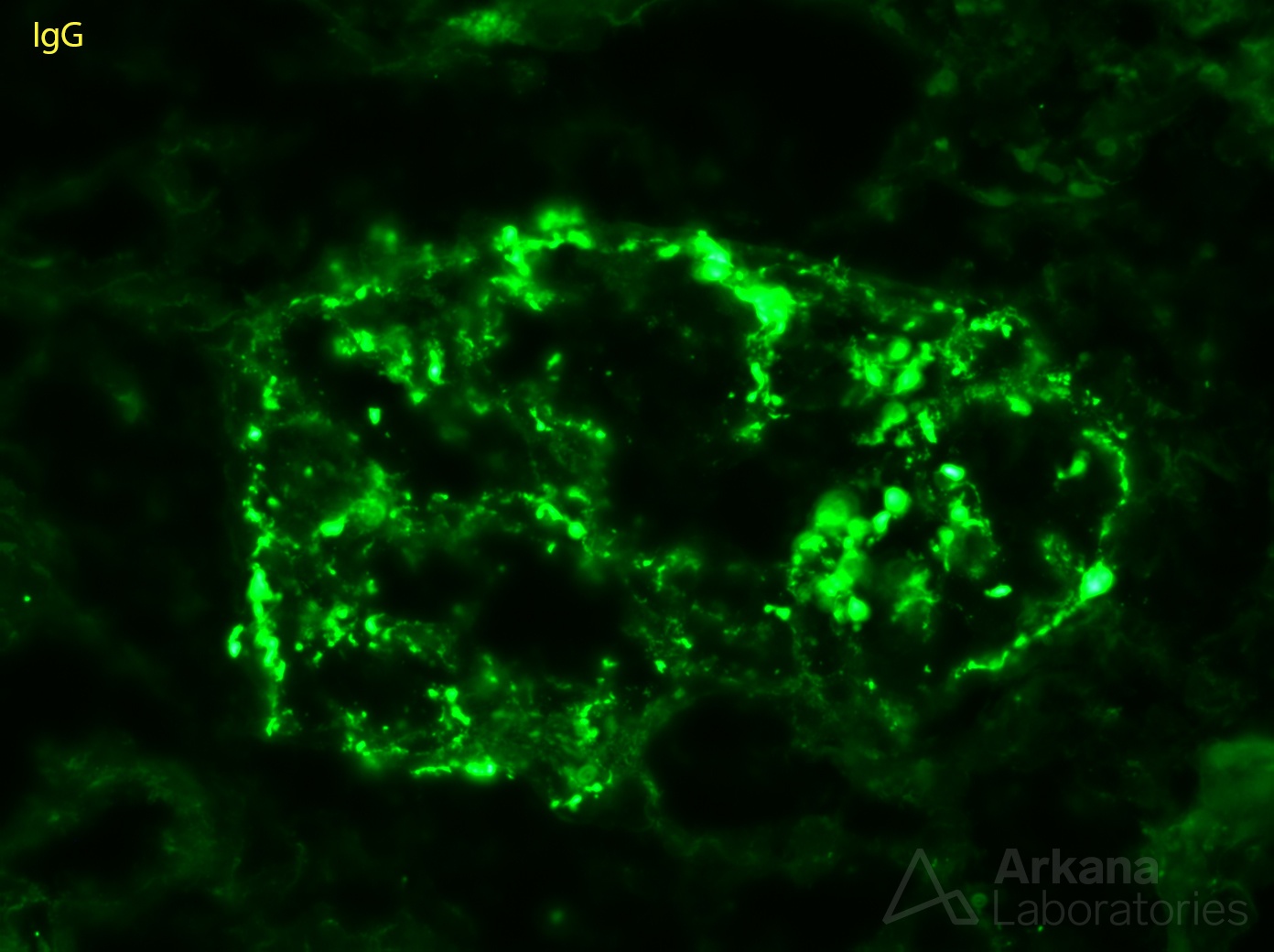 Infection-Associated Glomerulonephritis