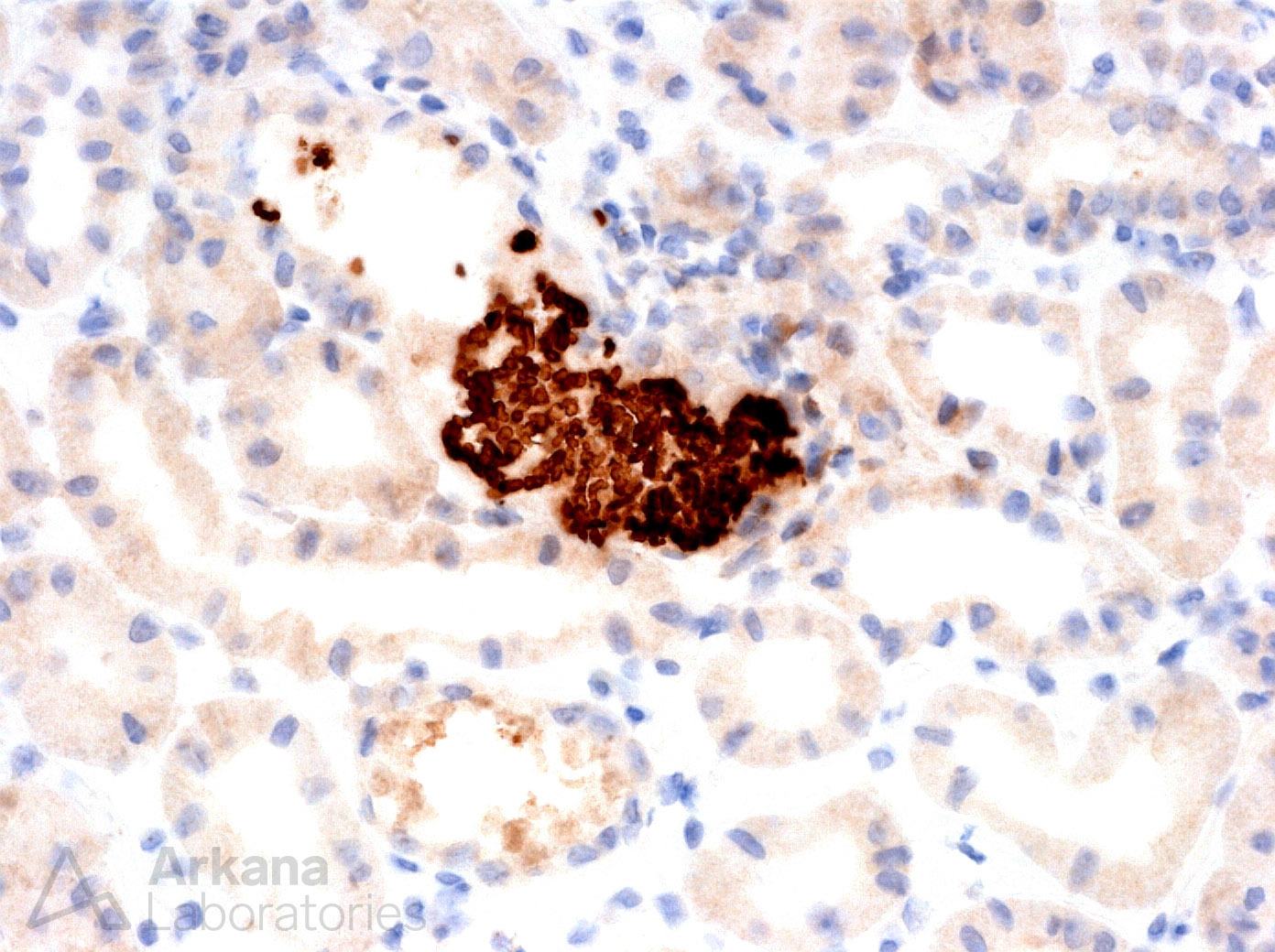 immunoperoxidase stain for myoglobin, myoglobin casts