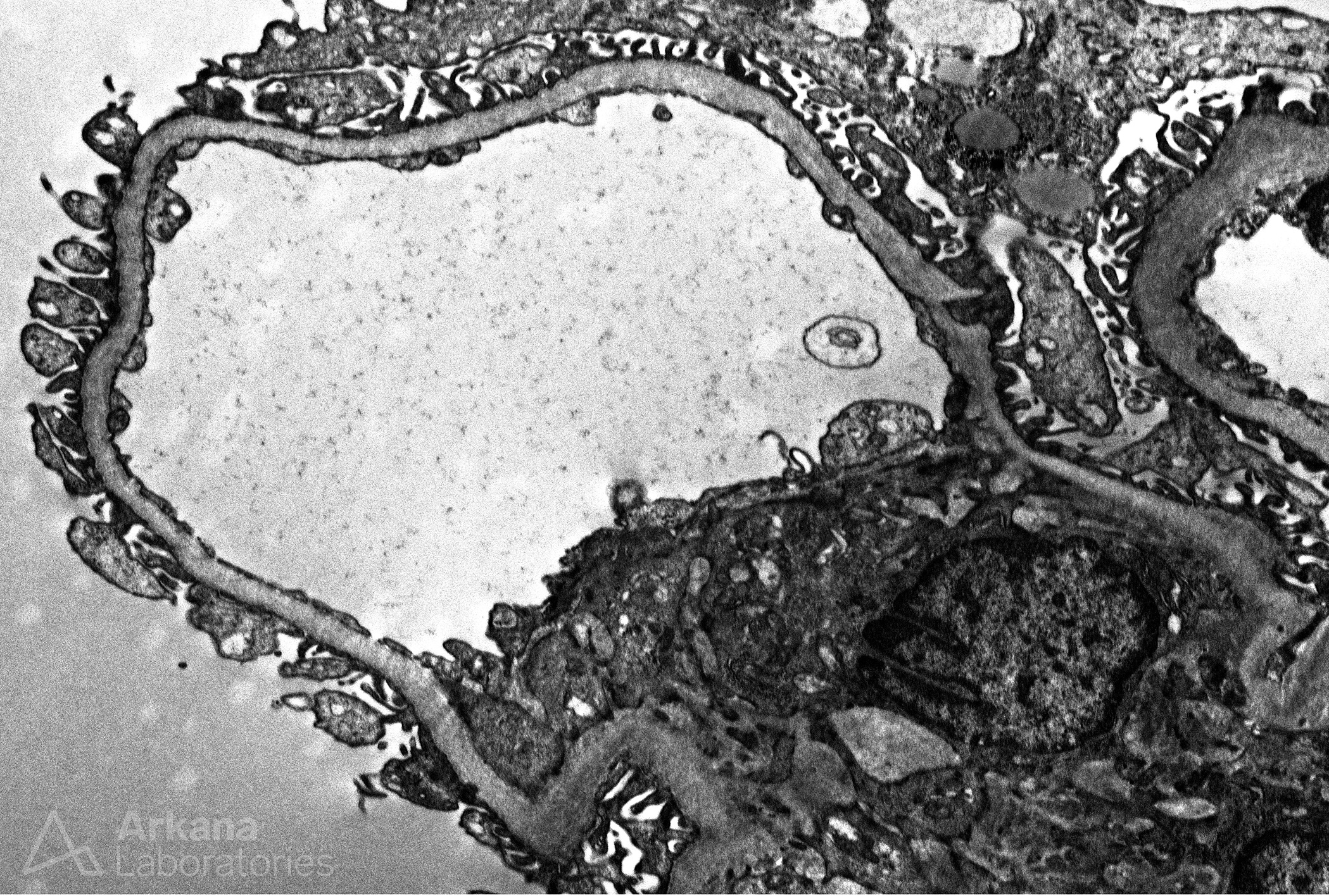 primary podocytopathy, secondary focal segmental glomerulosclerosis