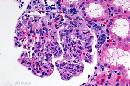 Infection-Associated Glomerulonephritis