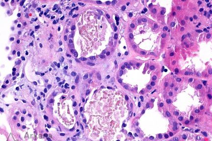 Myoglobin Casts