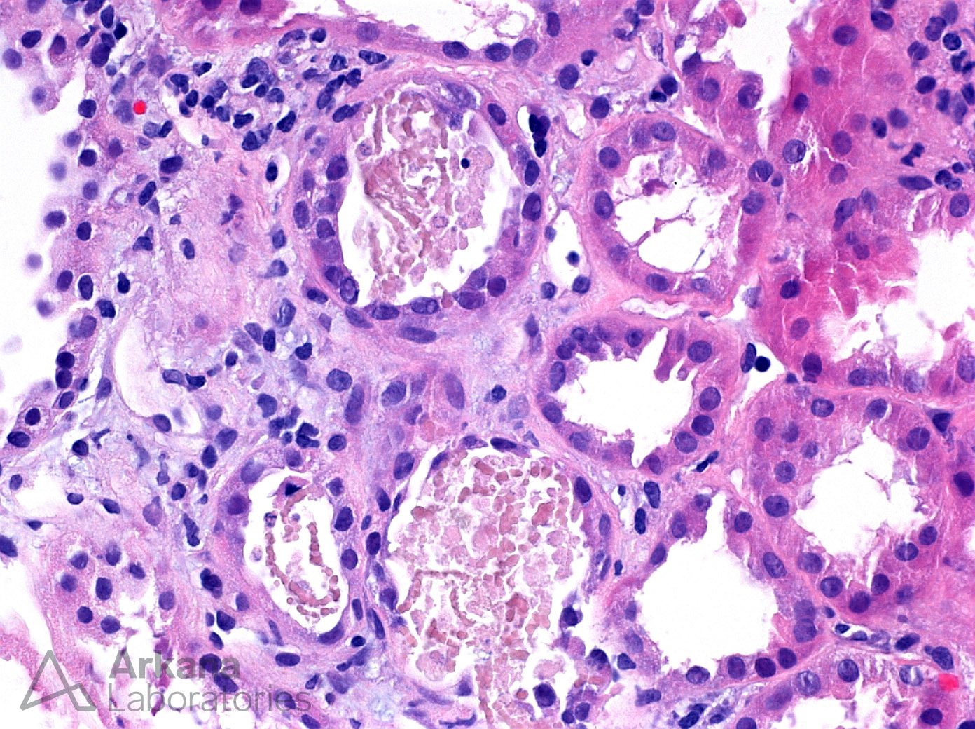 Myoglobin Casts