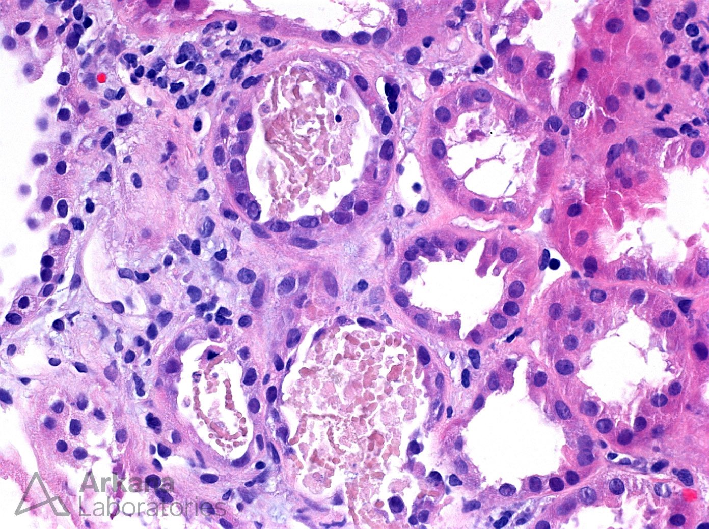 Myoglobin Casts