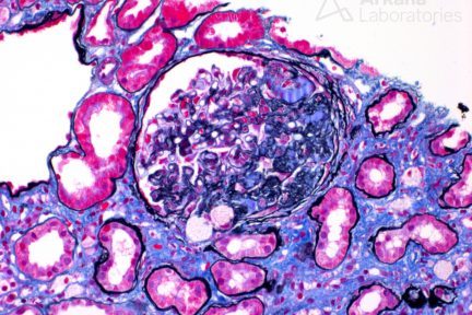 secondary focal segmental glomerulosclerosis