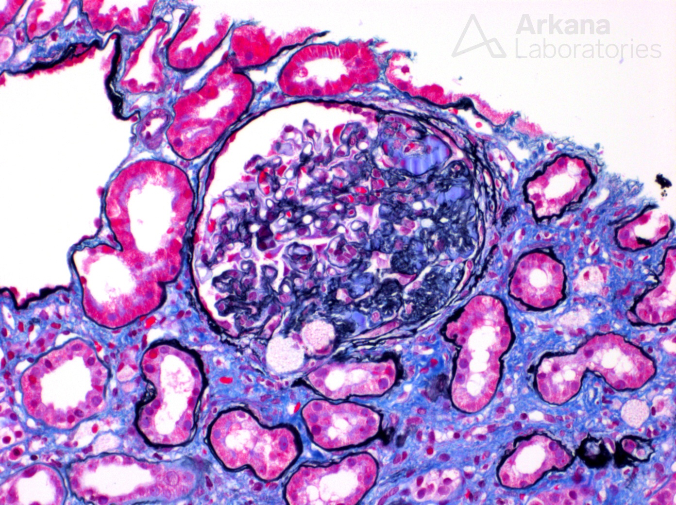 secondary focal segmental glomerulosclerosis