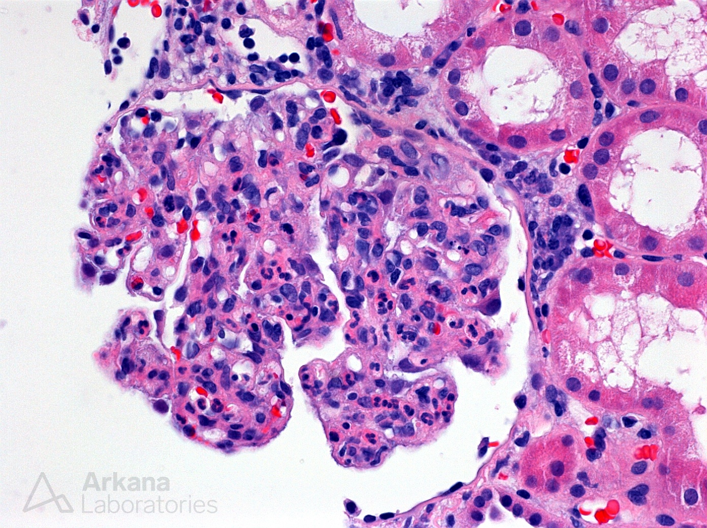 Infection-Associated Glomerulonephritis