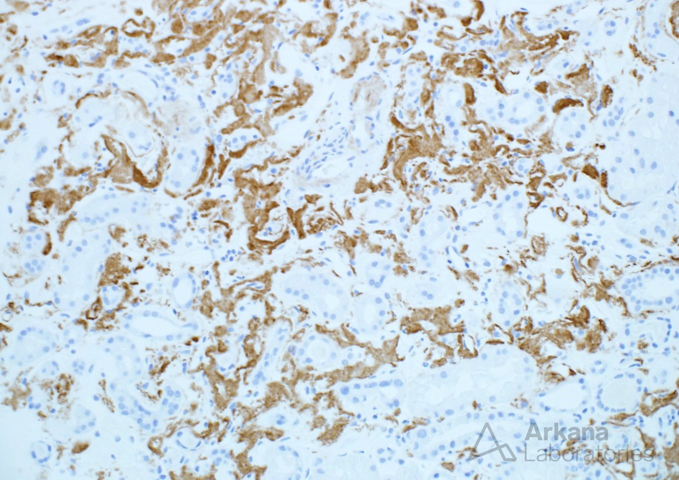 Amyloidosis, ALect2-Type