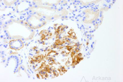 Fibrillary Glomerulopathy