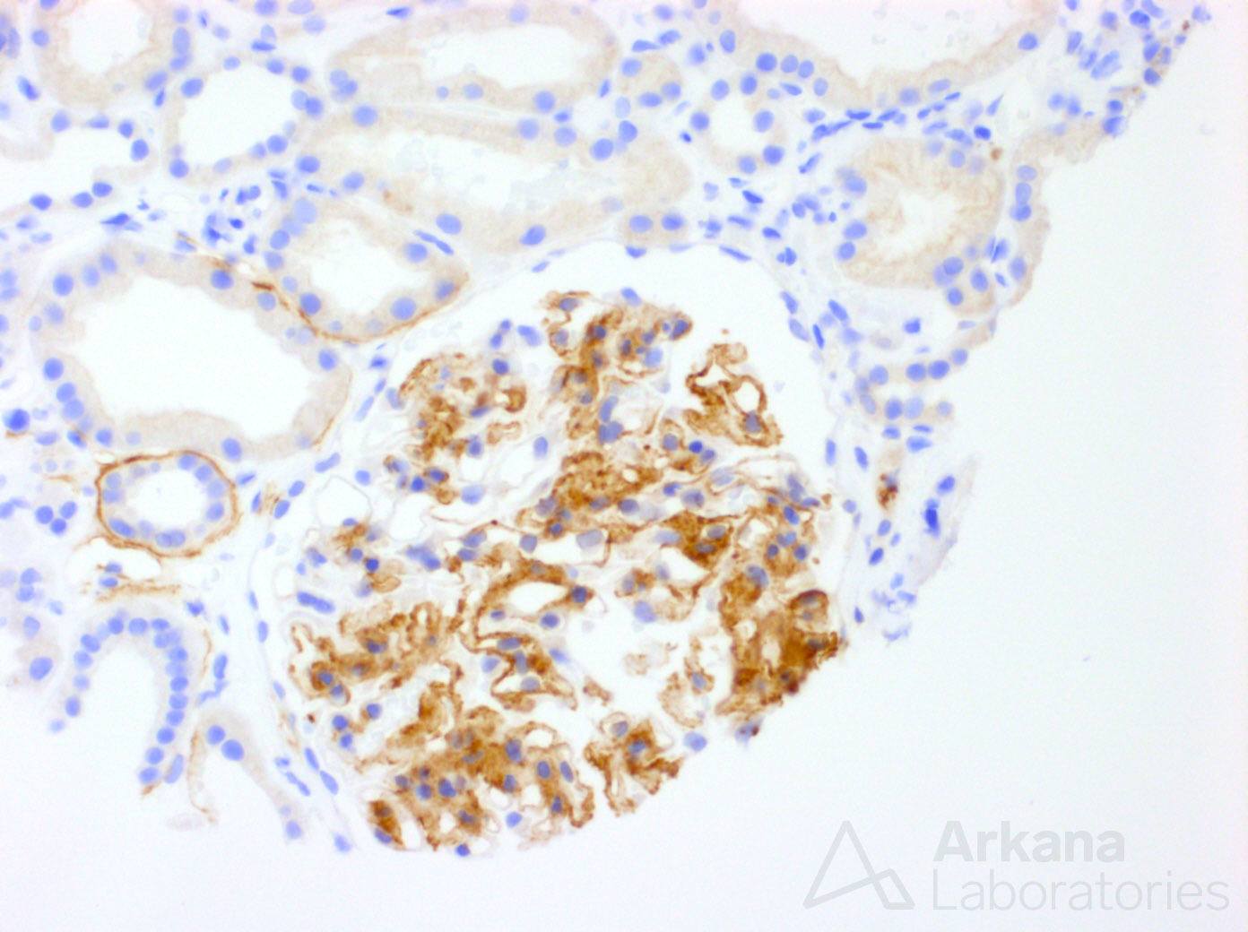 Fibrillary Glomerulopathy