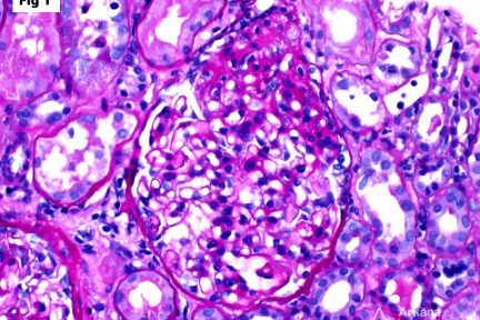 FSGS Tip Lesion