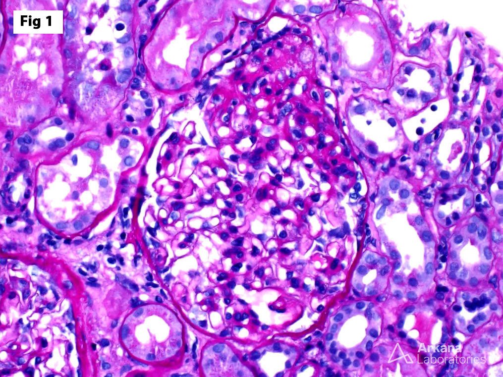 FSGS Tip Lesion