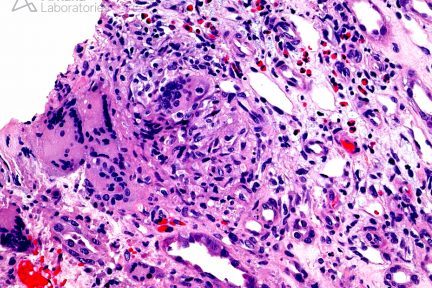 renal biopsy, arkana laboratories, renal tissue,granulomatous interstitial nephritis