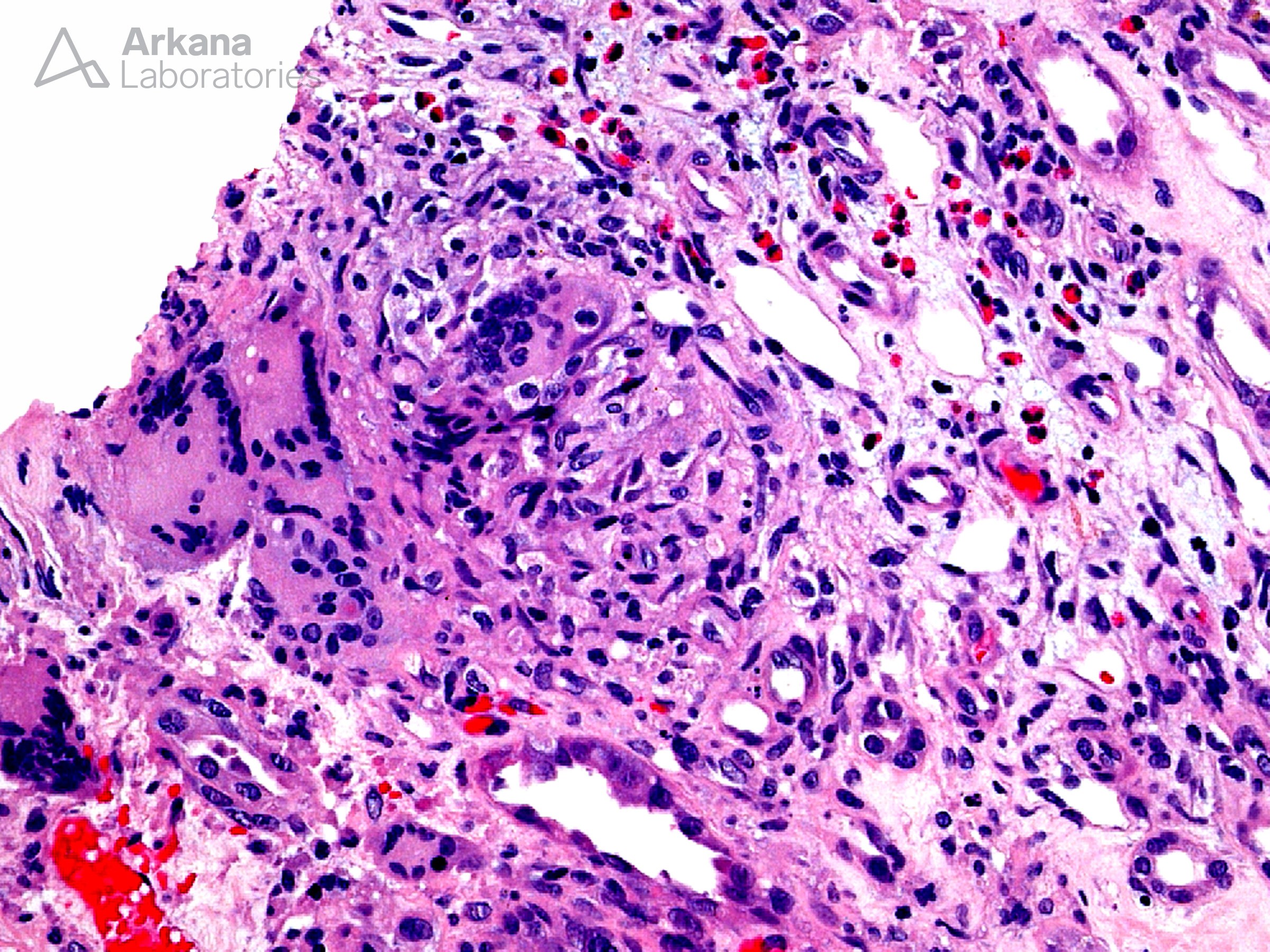 renal biopsy, arkana laboratories, renal tissue,granulomatous interstitial nephritis