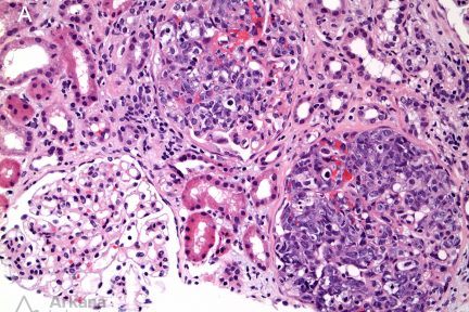 Intravascular Large B Cell Lymphoma, stained positive for CD20