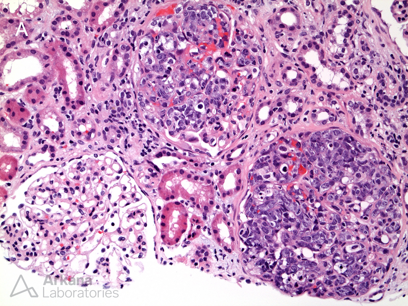 Intravascular Large B Cell Lymphoma, stained positive for CD20