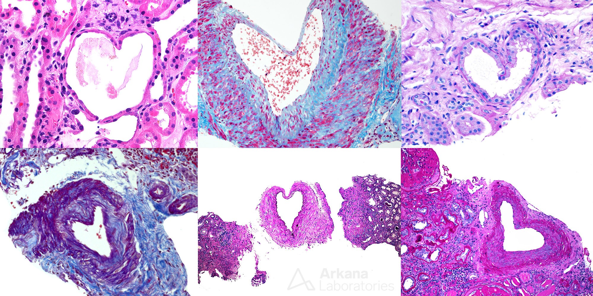 renal pathology, heart pathology, arkana laboratories, happy valentines day