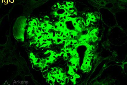 fibrillary glomerulopathy